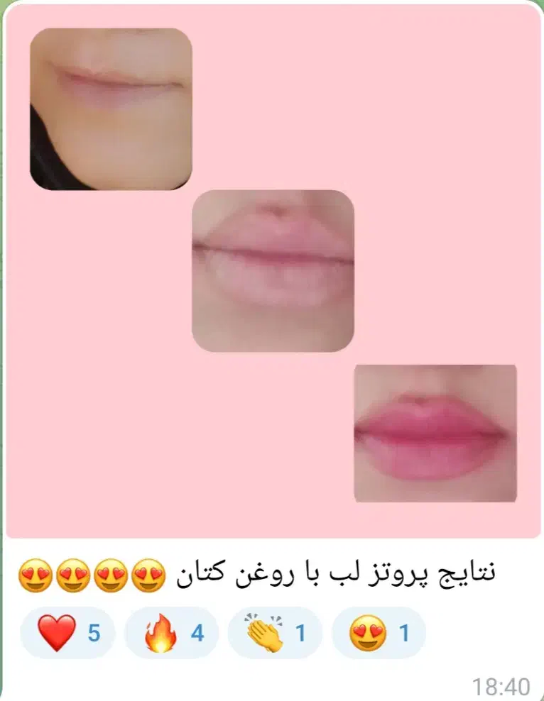 لب پرتزی میخوای|آرایشی، بهداشتی، درمانی|شیراز, ویلاشهر|دیوار