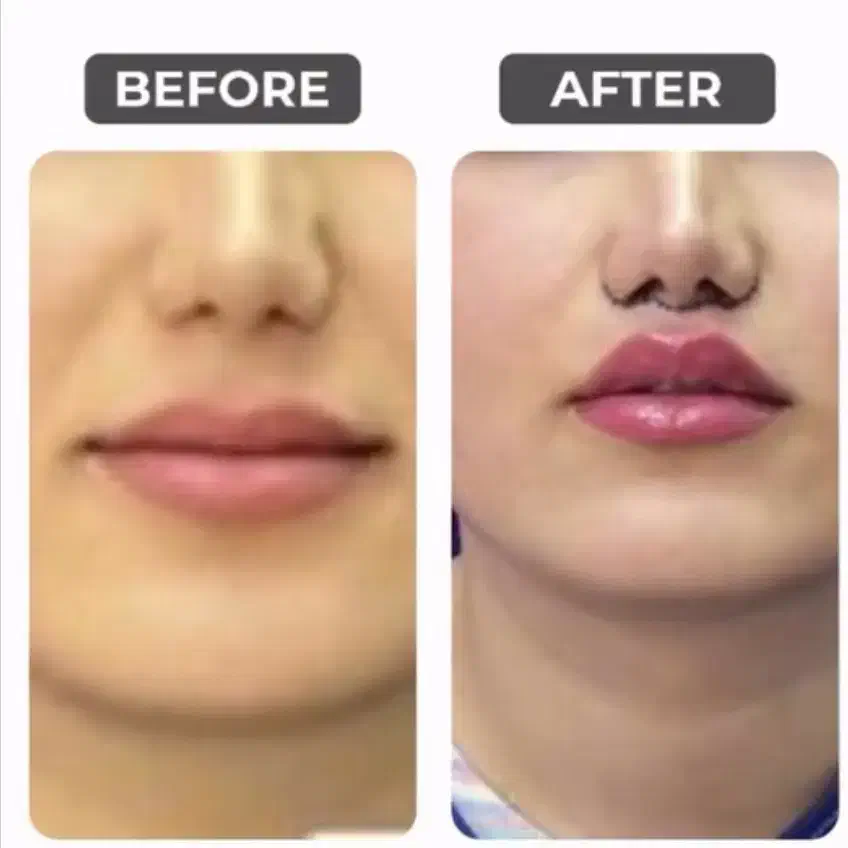 جشنواره بوتاکس و مزو به مدت محدود|خدمات آرایشگری و زیبایی|اصفهان, گلزار|دیوار