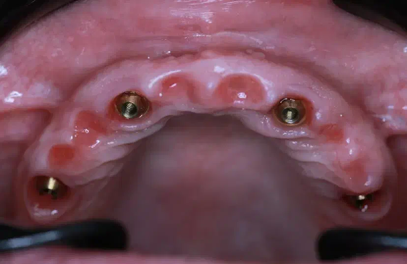 دندانپزشکی،ایمپلنت،اوردنچر با اقساط دو ساله|خدمات آرایشگری و زیبایی|اهر, |دیوار