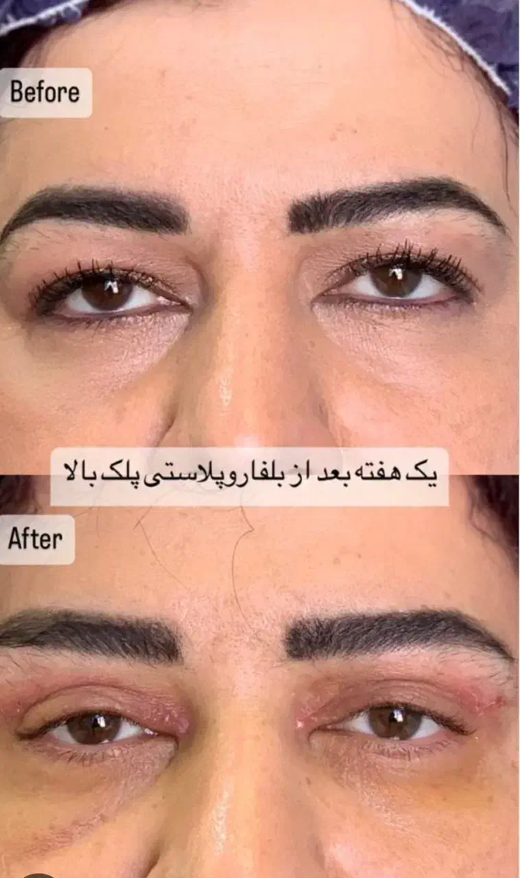 جشنواره پاییزه بلفاروپلاستی|خدمات آرایشگری و زیبایی|تهران, پاسداران|دیوار