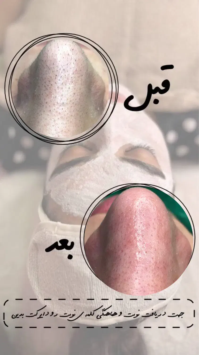 تخفیف فیشیال کلاسیک(رفع جوش سرسیاه)|خدمات آرایشگری و زیبایی|دوگنبدان, |دیوار