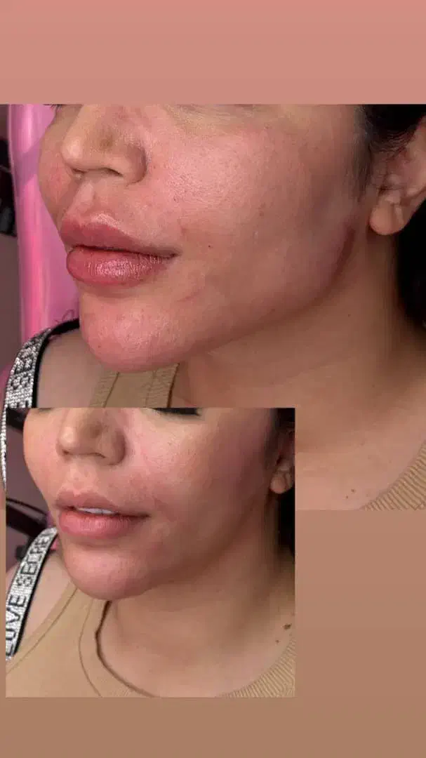 تزریقات ژل و بوتاکس و آنزیم|خدمات آرایشگری و زیبایی|اسلام‌شهر, شهرک مهدیه|دیوار