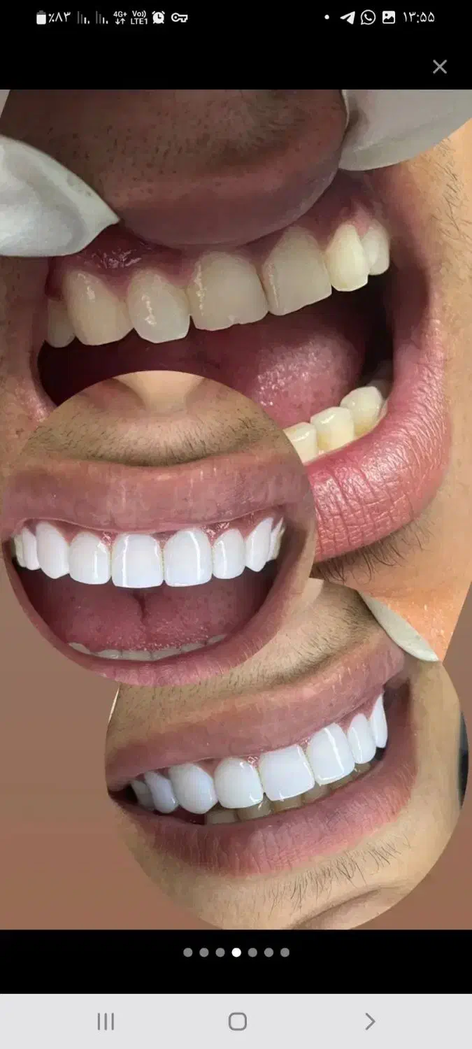 جشنواره کامپوزیت دندان|خدمات آرایشگری و زیبایی|شاهرود, |دیوار