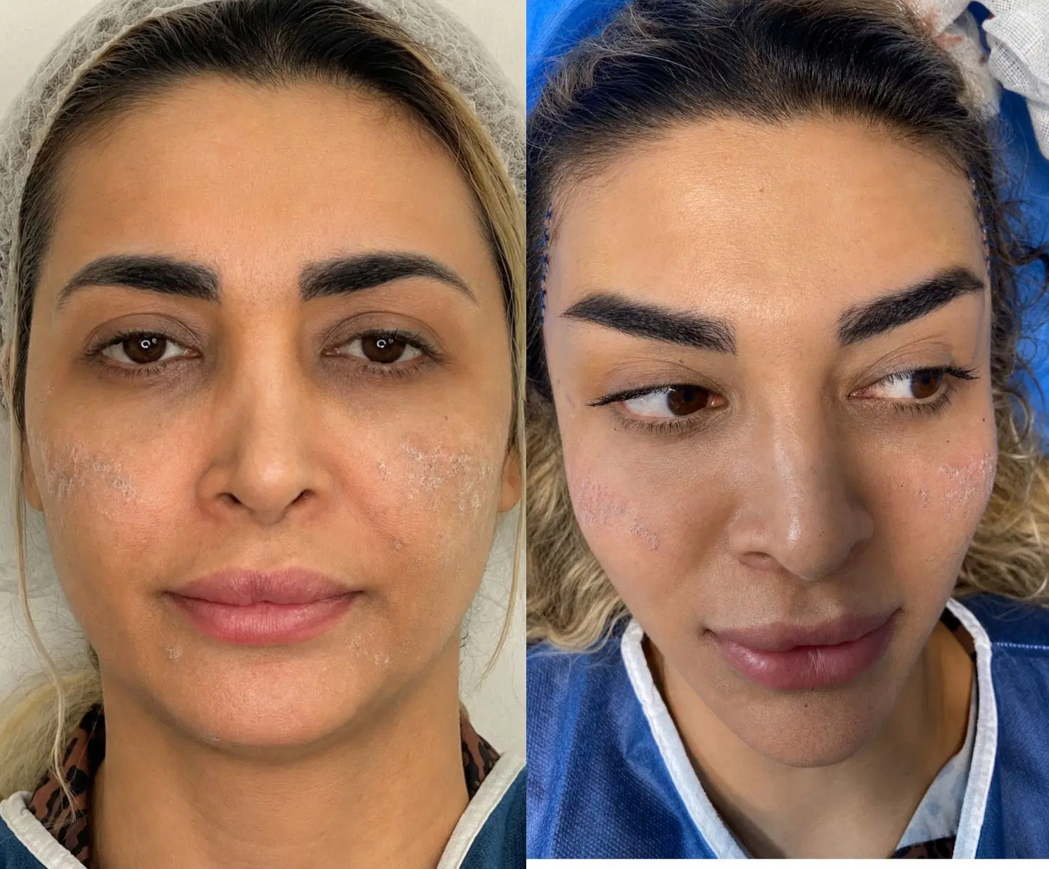 جراحی لیفت شقیقه دایرکت ابرو و تحتانی بخیه لیزری|خدمات زیبایی و سلامت|تهران, ایوانک|دیوار