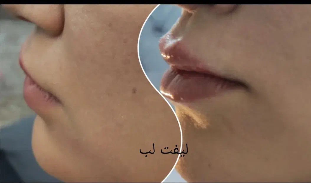ترریق ژل و بوتاکس|خدمات آرایشگری و زیبایی|اصفهان, کوی شهید کشوری|دیوار