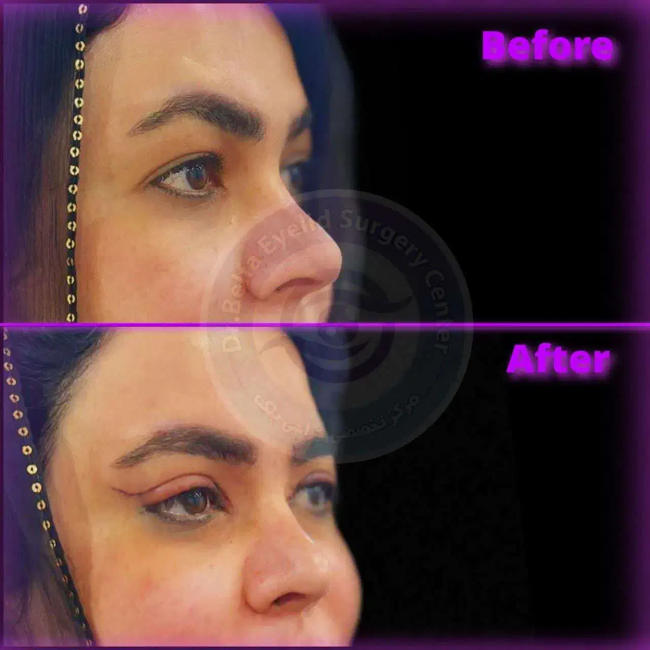 جشنواره ویژه بلفاروپلاستی(جراحی زیبایی پلک)|خدمات آرایشگری و زیبایی|دیلم, |دیوار