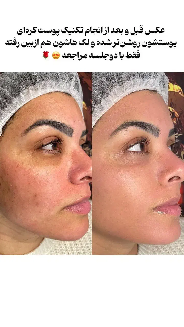 نیازمند دو مدل برای تکنیک پوست کرهای (هزینه مواد)|خدمات آرایشگری و زیبایی|ساری, |دیوار