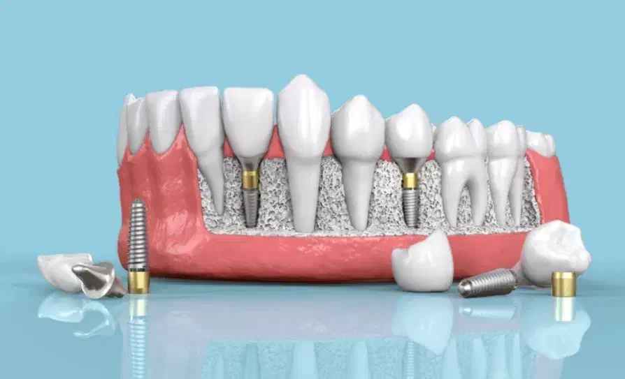 ایمپلنت مهر شفاء|خدمات آرایشگری و زیبایی|قم, حنیف نژاد|دیوار