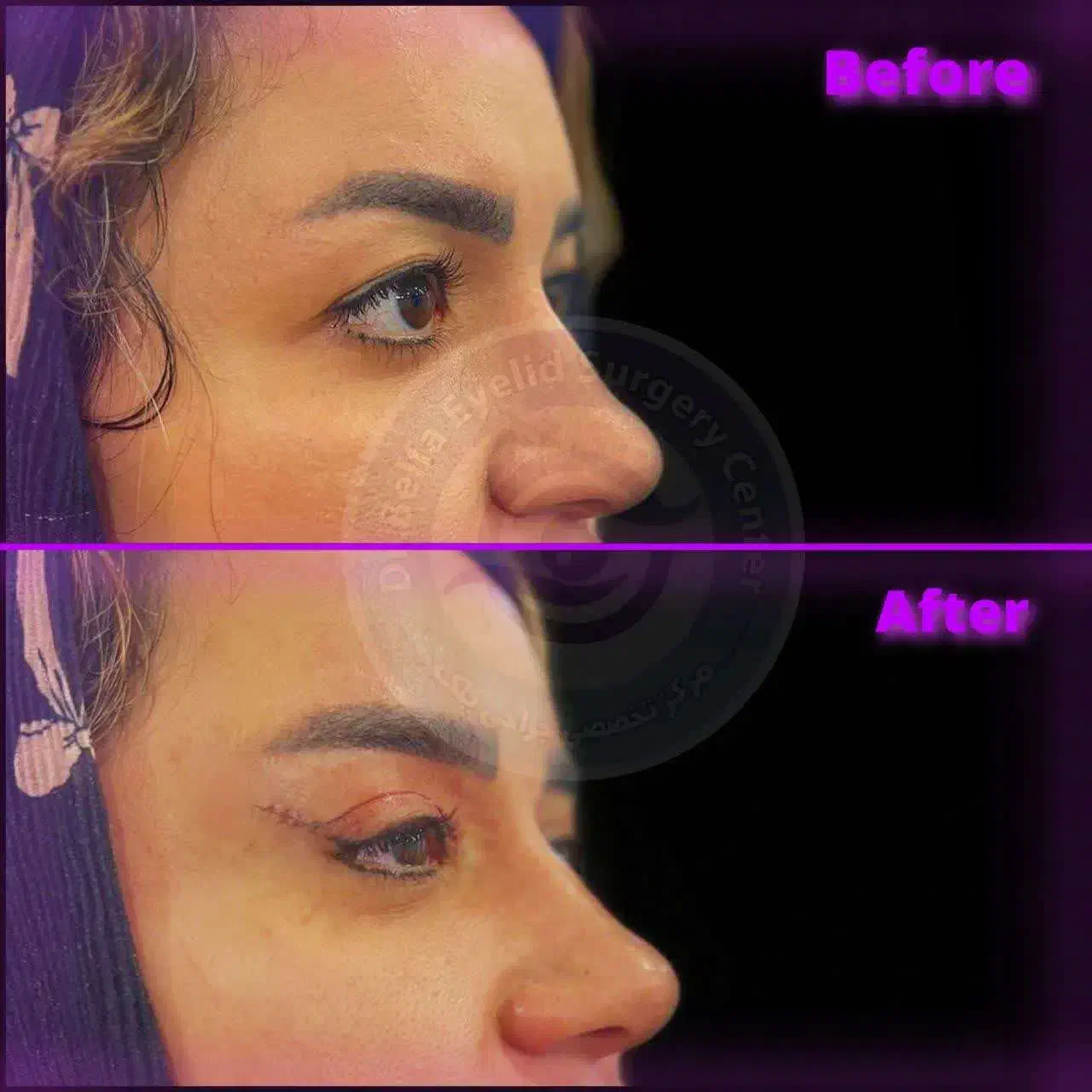 جشنواره ویژه بلفاروپلاستی(جراحی زیبایی پلک)|خدمات آرایشگری و زیبایی|بهبهان, |دیوار