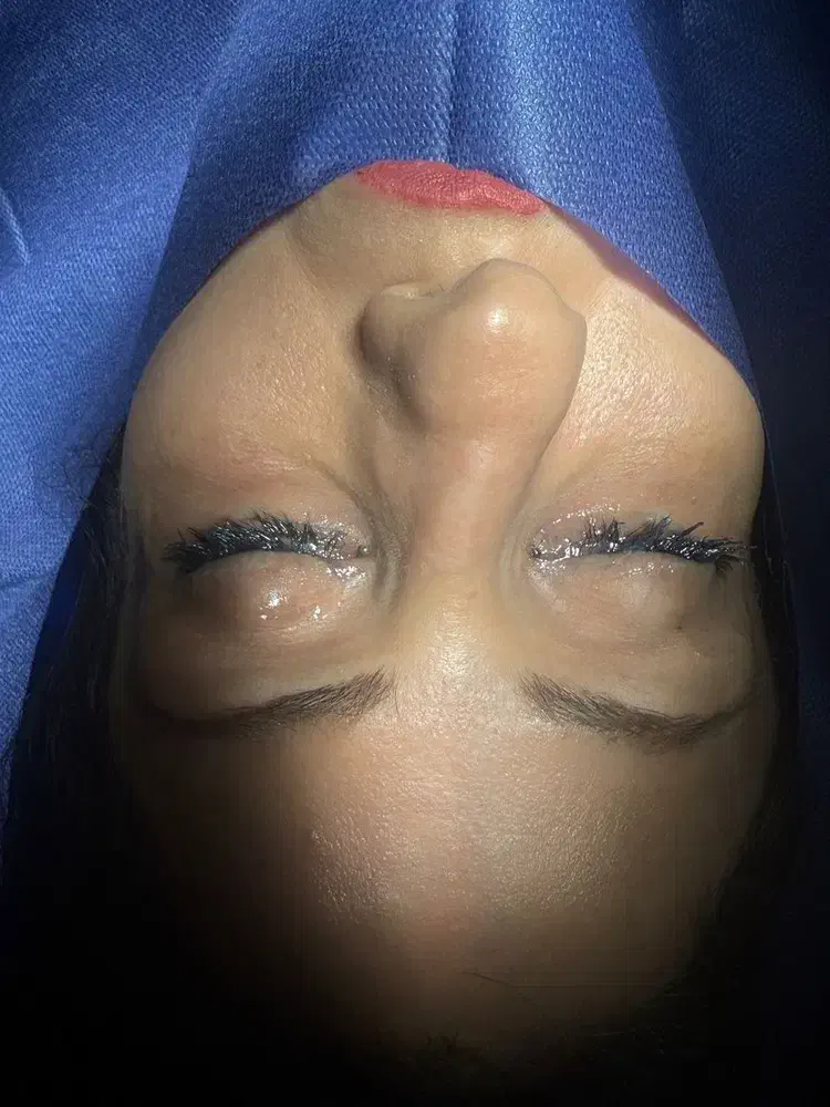 رینوپلاستی ۲۵میلیون|خدمات آرایشگری و زیبایی|قرچک, زیبا شهر|دیوار