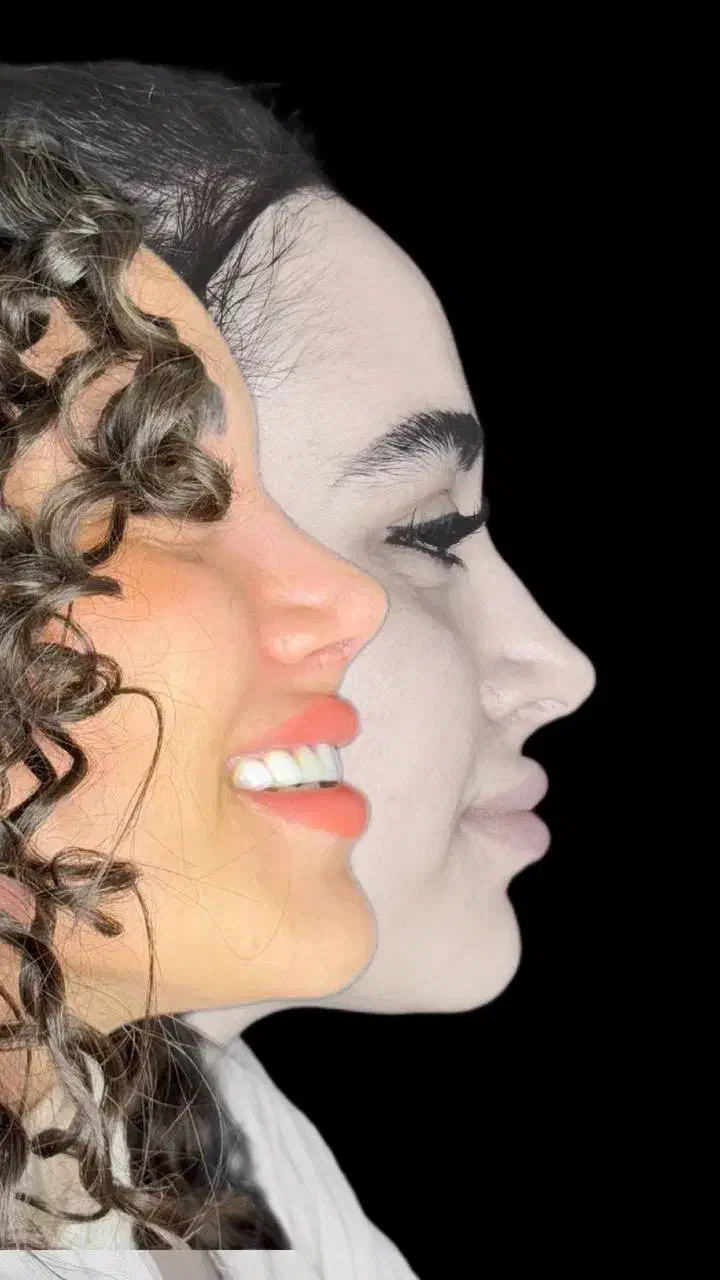 50%تخفیف ویژه عمل جراحی بینی بدون تامپون لیفت|خدمات آرایشگری و زیبایی|فردیس, طالقانی|دیوار