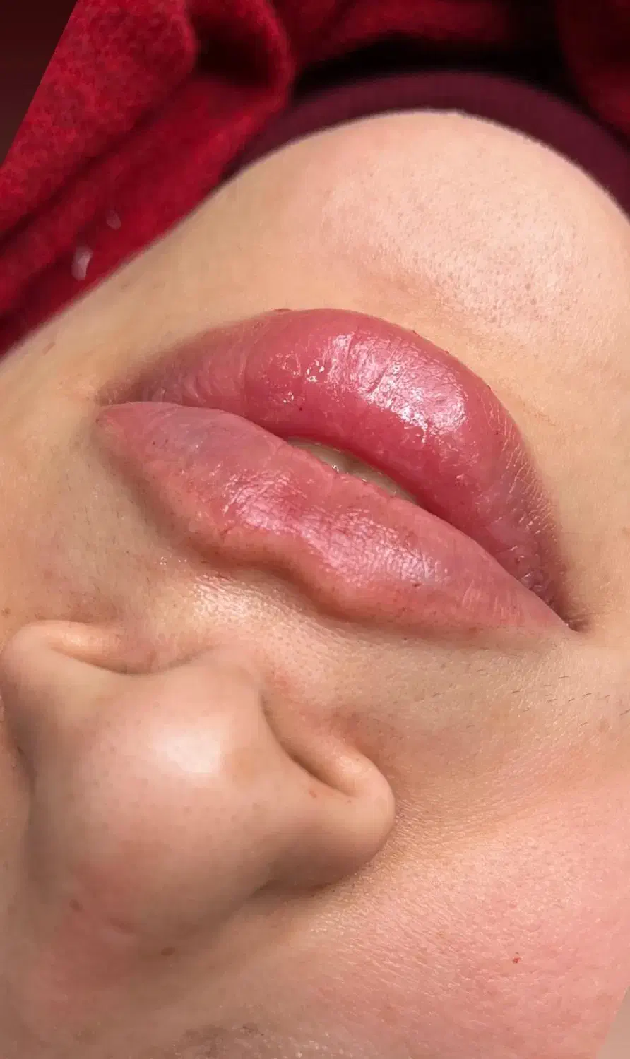 جشنواره تزریق فیلر،بوتاکس ،نخ،لاغری و هایفو|خدمات آرایشگری و زیبایی|تبریز, |دیوار