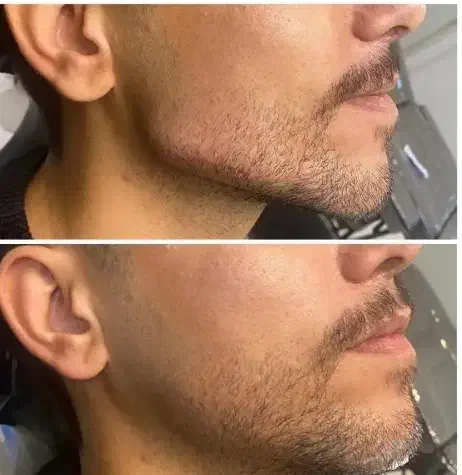 ژل لب فیلر بوتاکس پی ار پی فیلر گونه خط خنده|خدمات آرایشگری و زیبایی|کاشان, طالقانی|دیوار