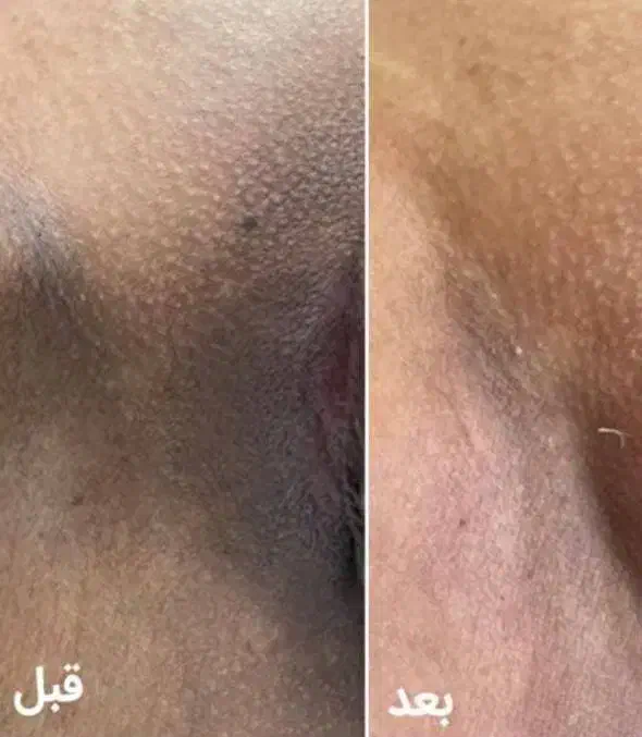 جشنواره یلدایی ژل بوتاکس پی ارپی فیلر بیکینی|خدمات آرایشگری و زیبایی|مشهد, سرافرازان|دیوار