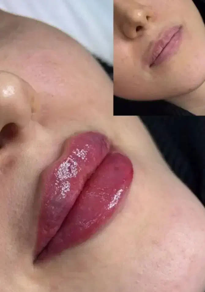 ژل بوتاکس مزوتراپی فیلرکانتورینگ|خدمات آرایشگری و زیبایی|چهارباغ, |دیوار