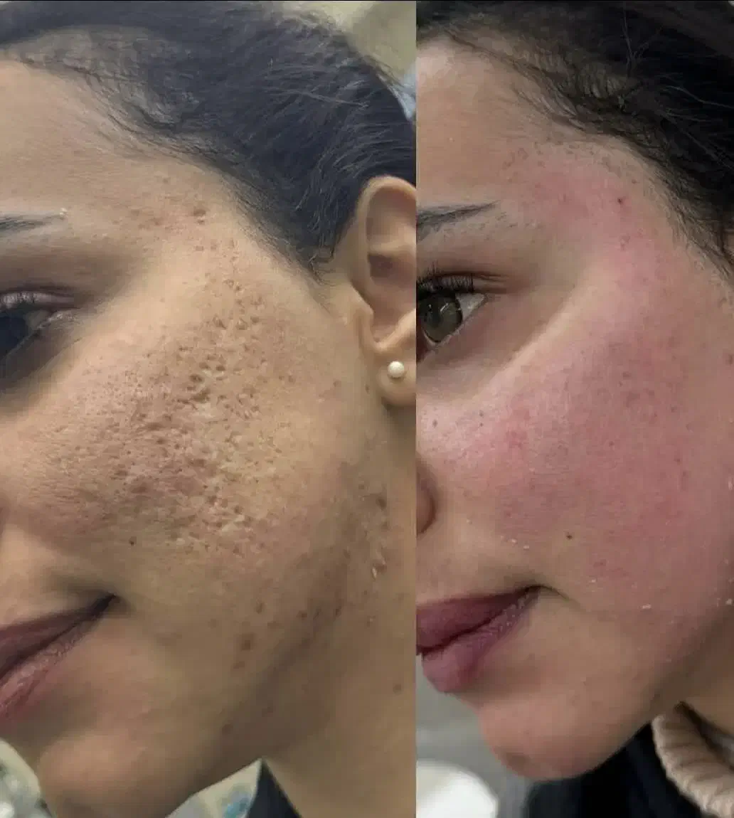 تخفیف ویژه حذف اسکار،منافذوتیرگی ها باco2+با مزو|خدمات آرایشگری و زیبایی|تهران, زعفرانیه|دیوار