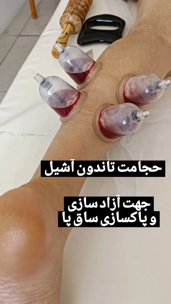 آموزش دوره تخصصی حجامت فصد زالو بادکش|خدمات آموزشی|کرج, کمال‌شهر|دیوار