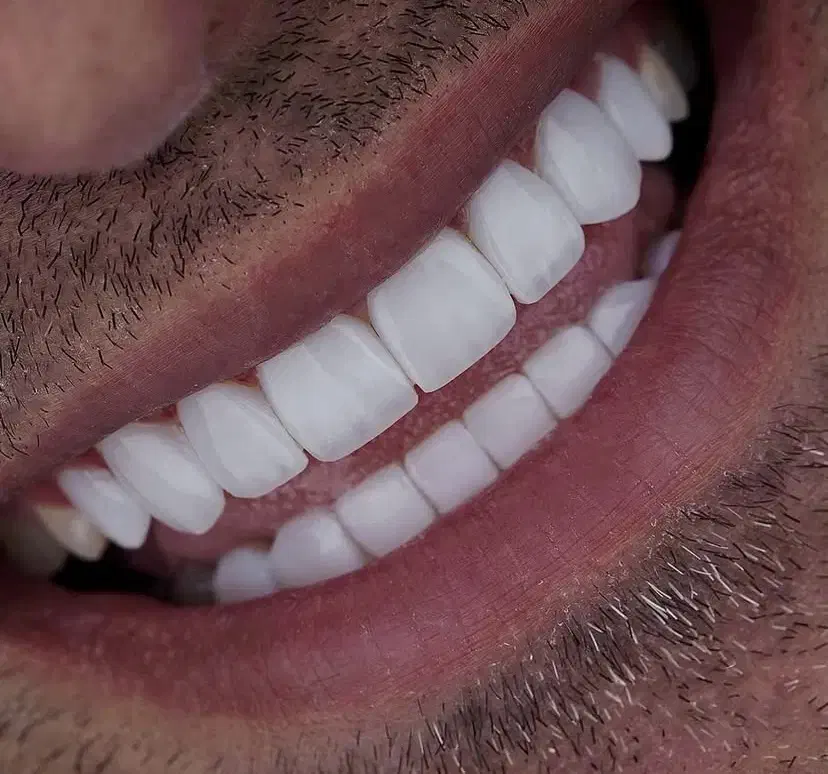 دندانپزشکی،ایمپلنت،اوردنچر با اقساط دو ساله|خدمات آرایشگری و زیبایی|اهر, |دیوار