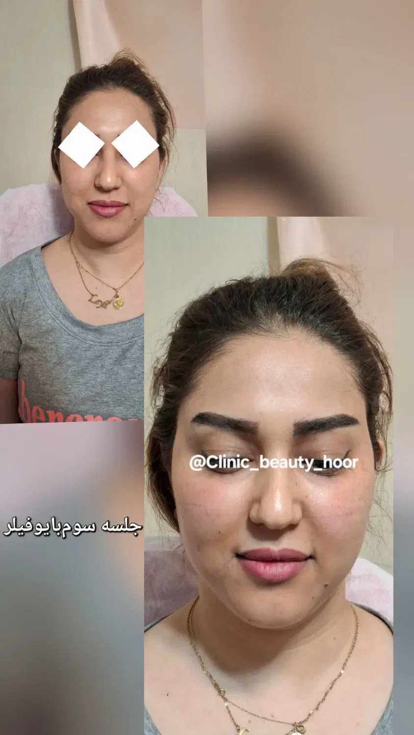 تزریق ژل طبیعی فیلر بوتاکس(کلینیک زیبایی گلد)|خدمات آرایشگری و زیبایی|سنندج, |دیوار