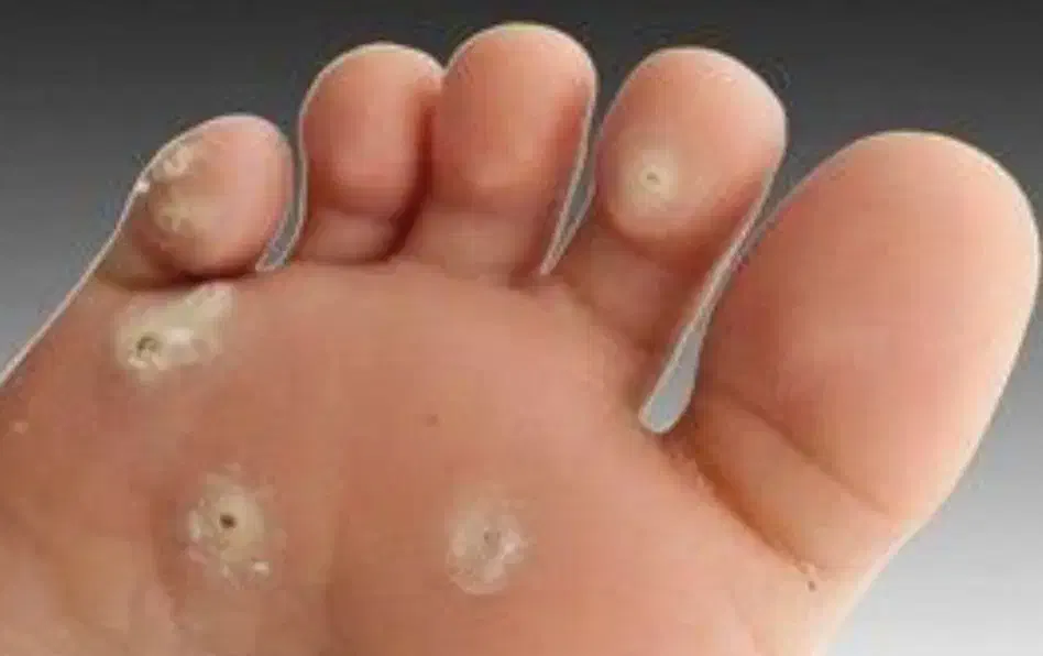 حذف قطعی میخچه|خدمات آرایشگری و زیبایی|بوکان, |دیوار