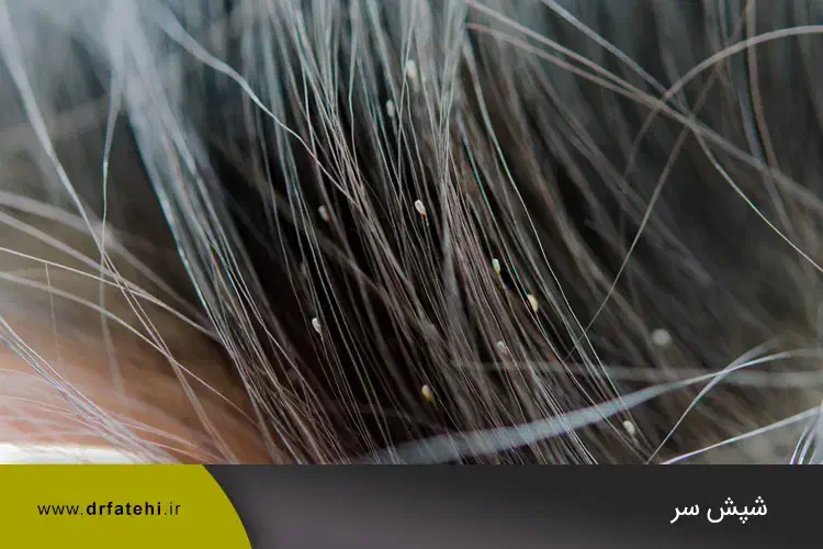 پودر شپش صدرصد اصل وتضمینی|آرایشی، بهداشتی، درمانی|پارس‌آباد, |دیوار