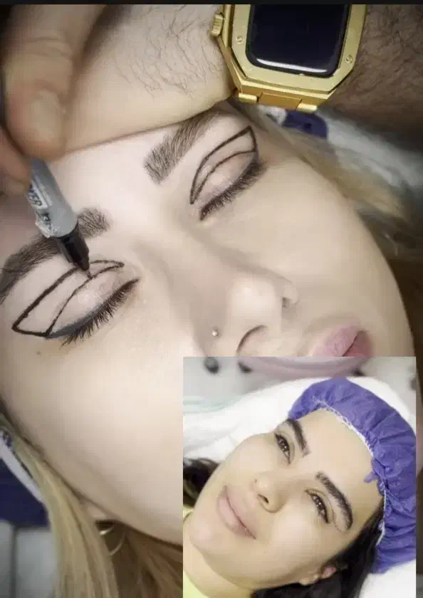 بلفاروپلاستی رفع افتادگی پلک لیزری/سانترال/بوکالفت|خدمات آرایشگری و زیبایی|تهران, هفت حوض|دیوار