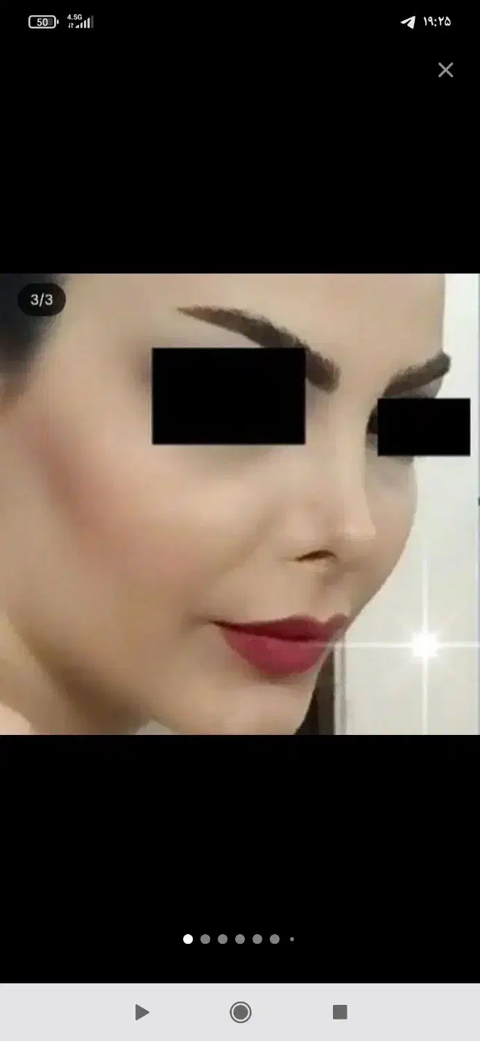 جشنواره لیپو .مامو .بینی بلفارو کل صورت .چک صیادی|خدمات آرایشگری و زیبایی|تهران, دروس|دیوار