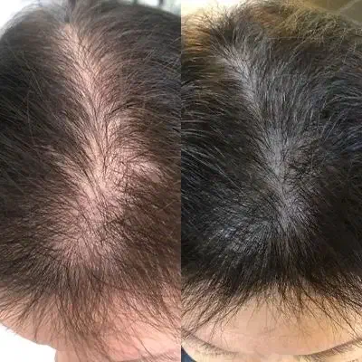 اسکالپ تراپی سر|خدمات آرایشگری و زیبایی|شاهین‌شهر, چمران|دیوار