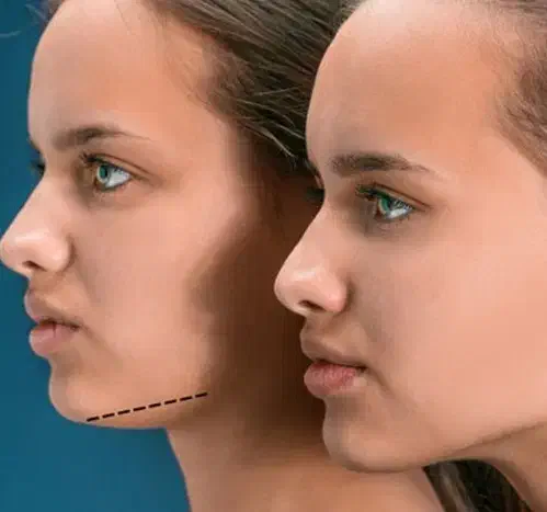 رفع غبغب|خدمات آرایشگری و زیبایی|بوشهر, |دیوار