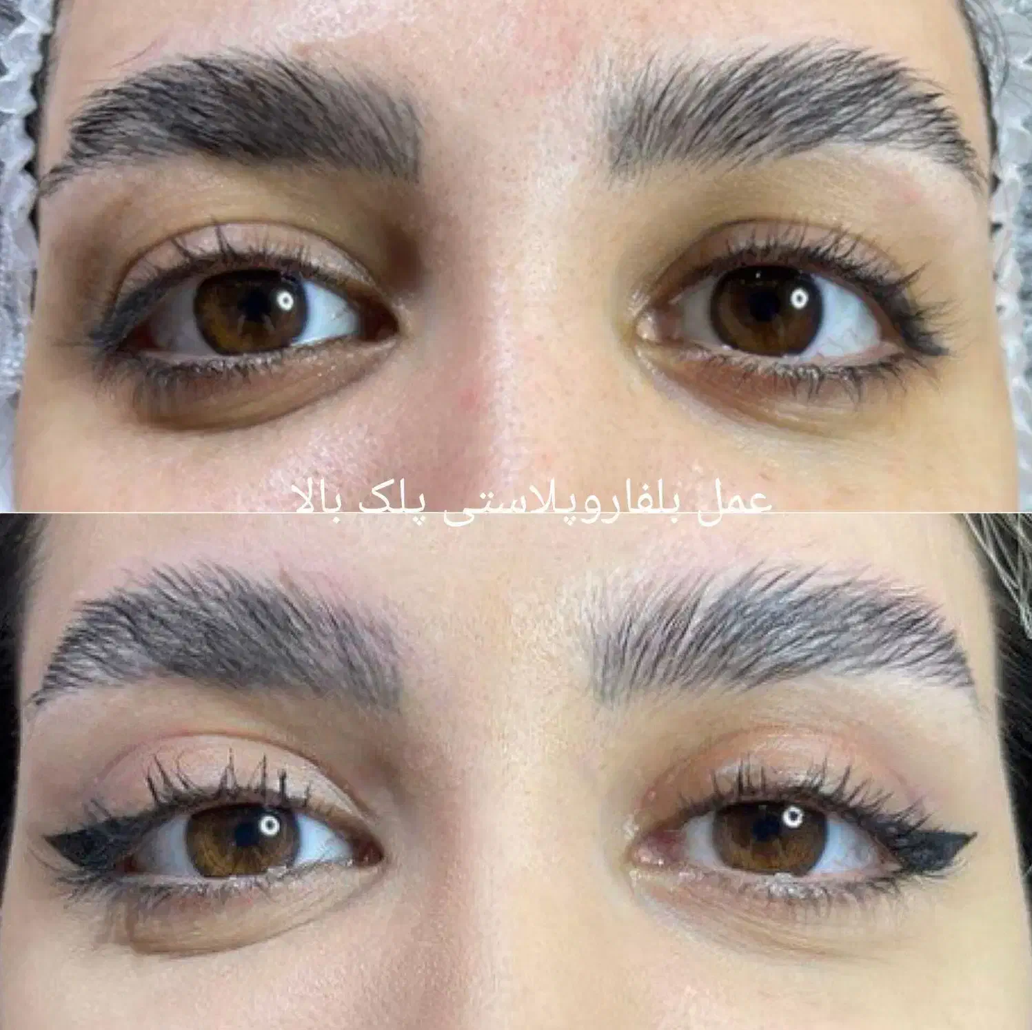 جشنواره بلفاروپلاستی پلک غبغب سانترال ژل چربی|خدمات آرایشگری و زیبایی|قم, بلوار امین و ساحلی|دیوار