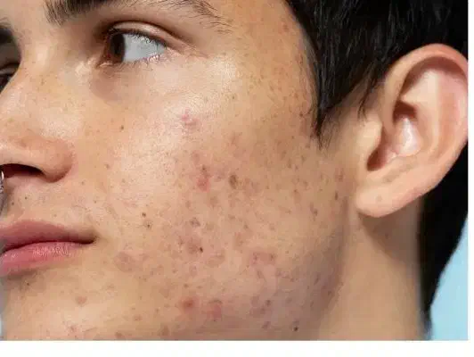 جوش یا لک و جای جوش در صورت و بدن|آرایشی، بهداشتی، درمانی|شیراز, لشکری‎|دیوار