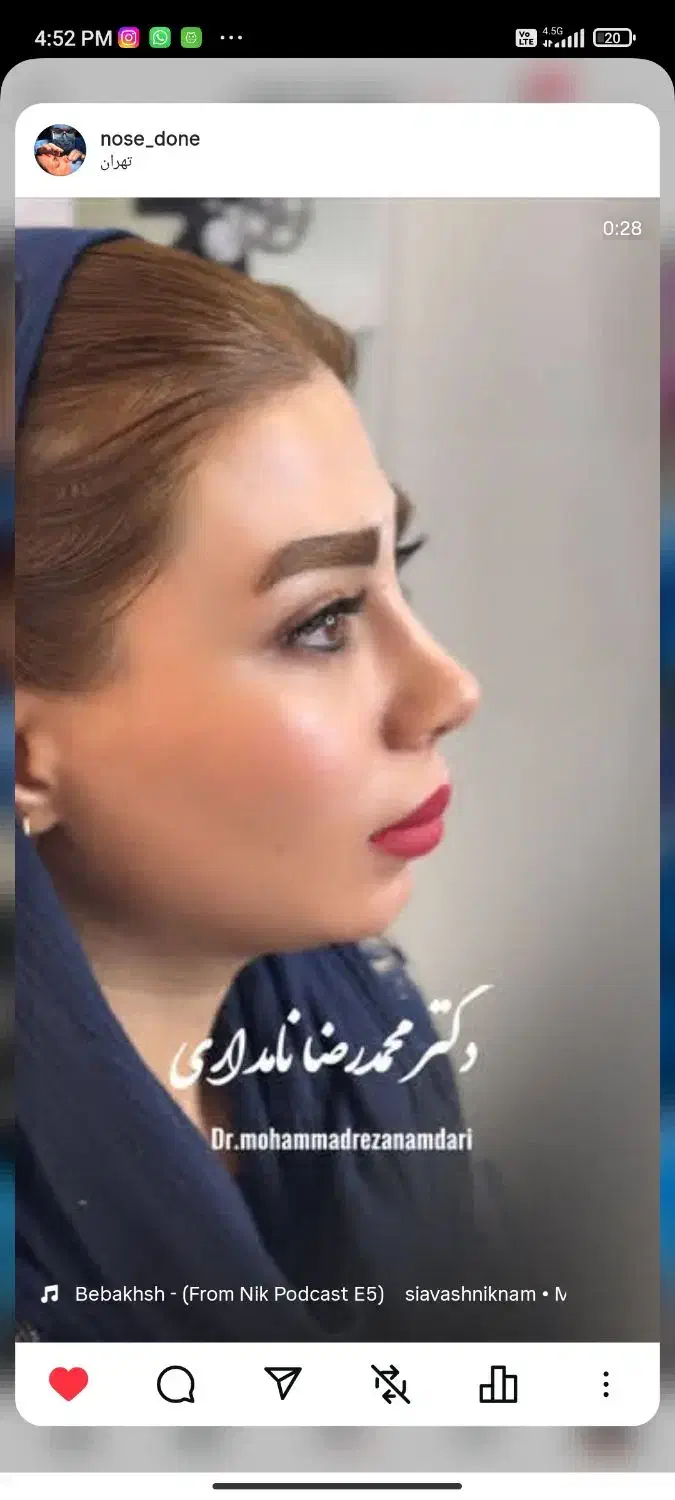 جراحی بینی ۲۹ میلیون فقط ۸ اذر|خدمات آرایشگری و زیبایی|قم, بکایی|دیوار