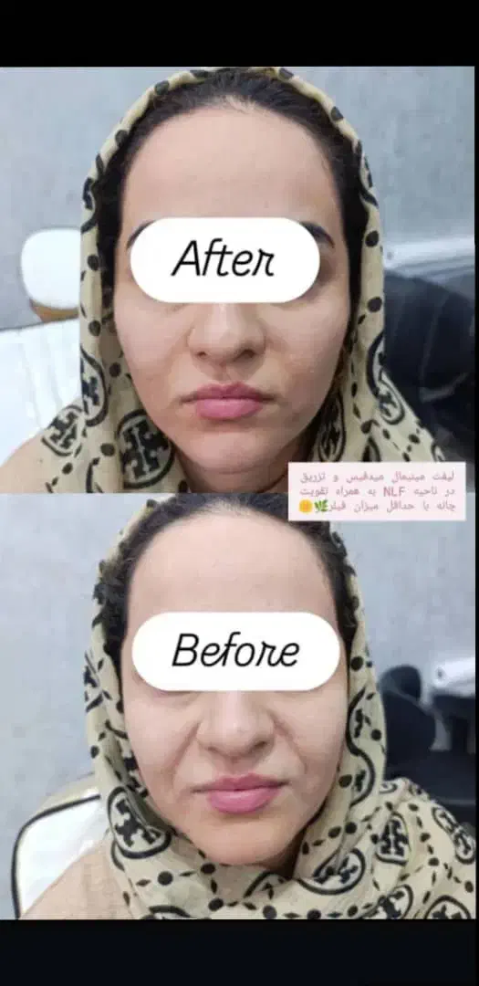 تزریق تمام اقساط بدون پیش پرداخت ژل،بوتاکس،مزو|خدمات آرایشگری و زیبایی|قم, بکایی|دیوار