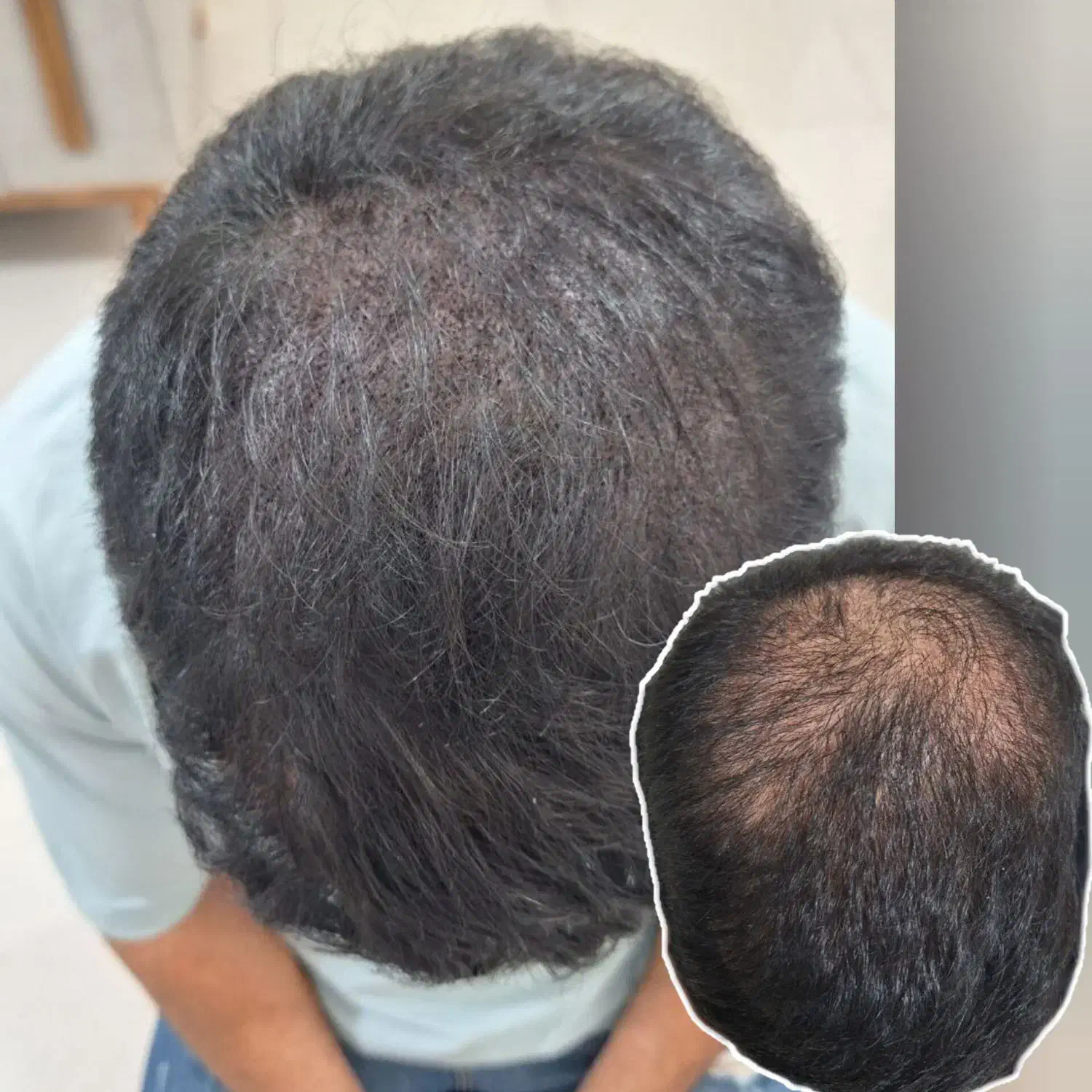 میکرواسکالپ / مکمل کاشت مو|خدمات آرایشگری و زیبایی|دوگنبدان, |دیوار