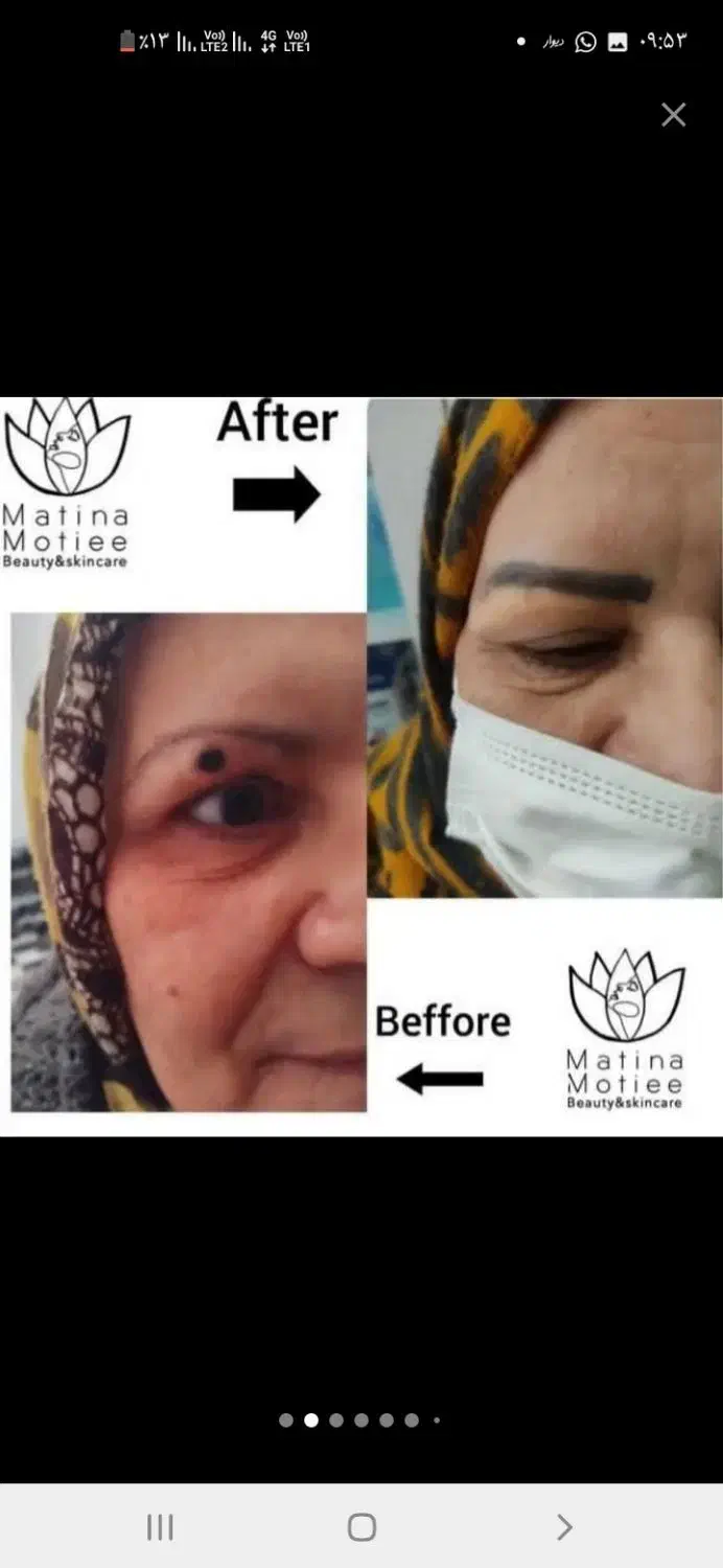 فیشال تخصصی، برداشت خال و ککو مک، ژل و بوتاکس|خدمات آرایشگری و زیبایی|شاهرود, |دیوار