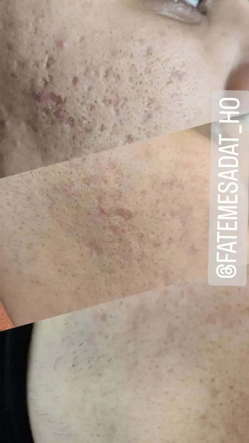 حذف دائمی کک و مک|خدمات آرایشگری و زیبایی|تربت جام, المهدی|دیوار