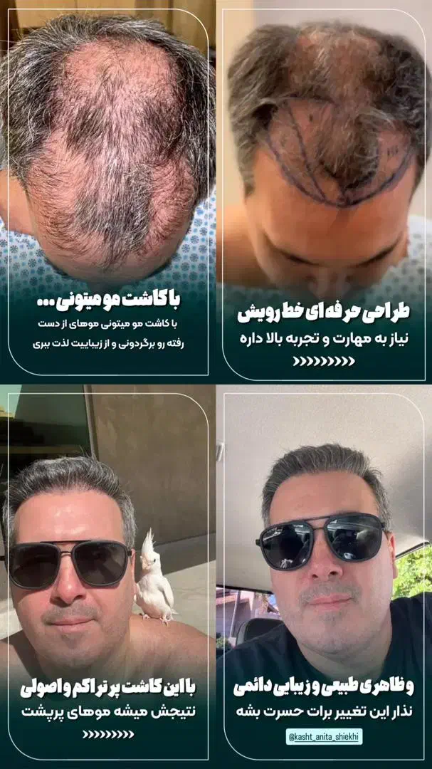 کاشت مو فقط 8700|خدمات آرایشگری و زیبایی|شیراز, معالی‌آباد|دیوار