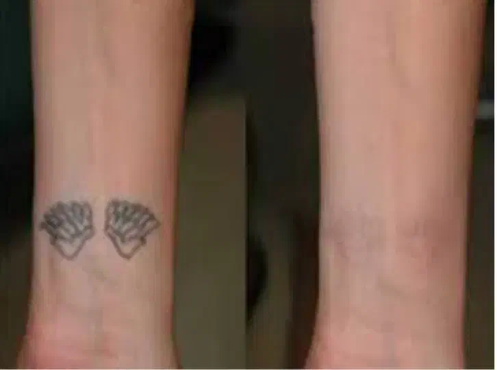 حذف تاتو و خالکوبی با لیزر کیوسوئیچ|خدمات آرایشگری و زیبایی|محمدشهر, محمدشهر|دیوار