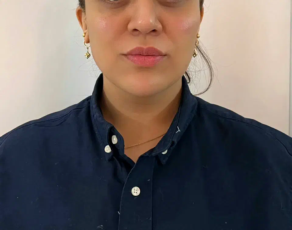 تزریق ژل لب تکنیک Mوبوتاکس|خدمات آرایشگری و زیبایی|تهران, شهرک ولیعصر جنوبی|دیوار