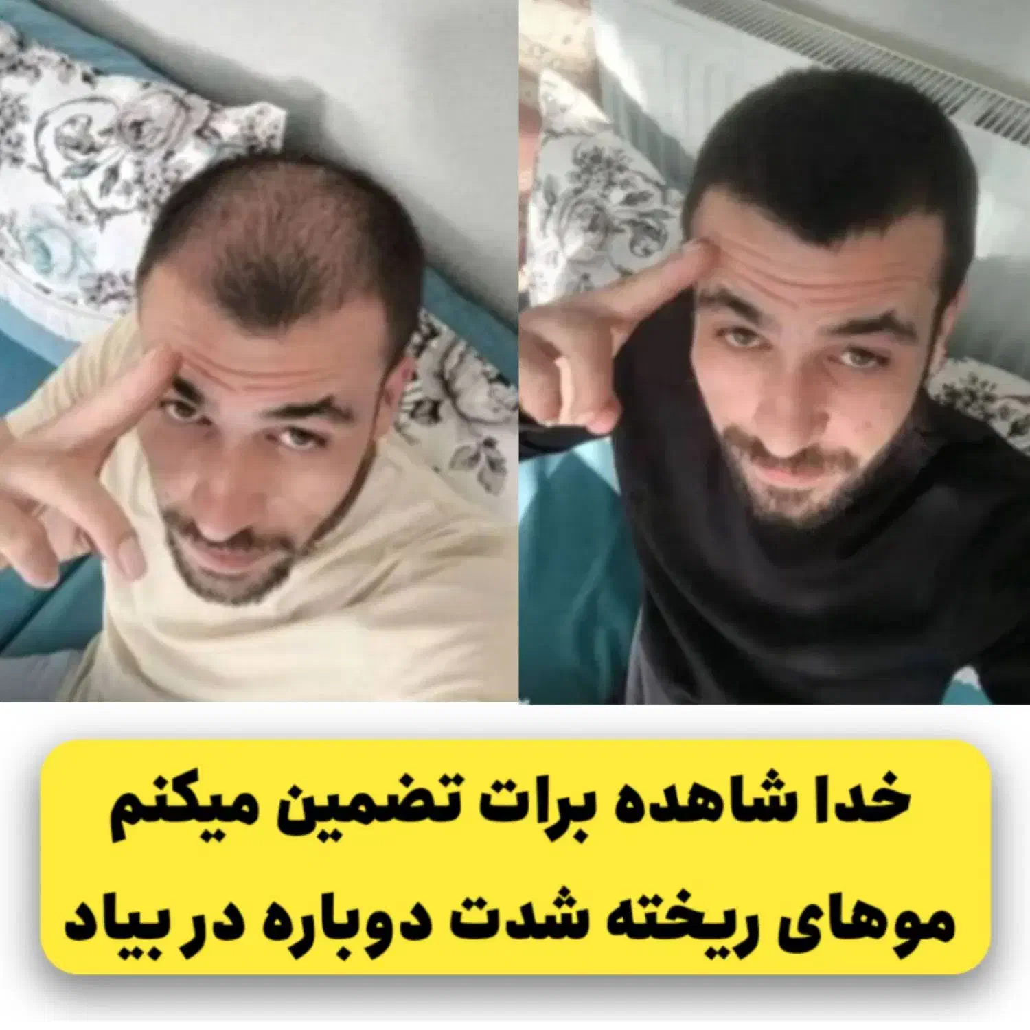 رویش مجدد مو تضمینی و قسطی|آرایشی، بهداشتی، درمانی|رشت, بلوار گیلان|دیوار