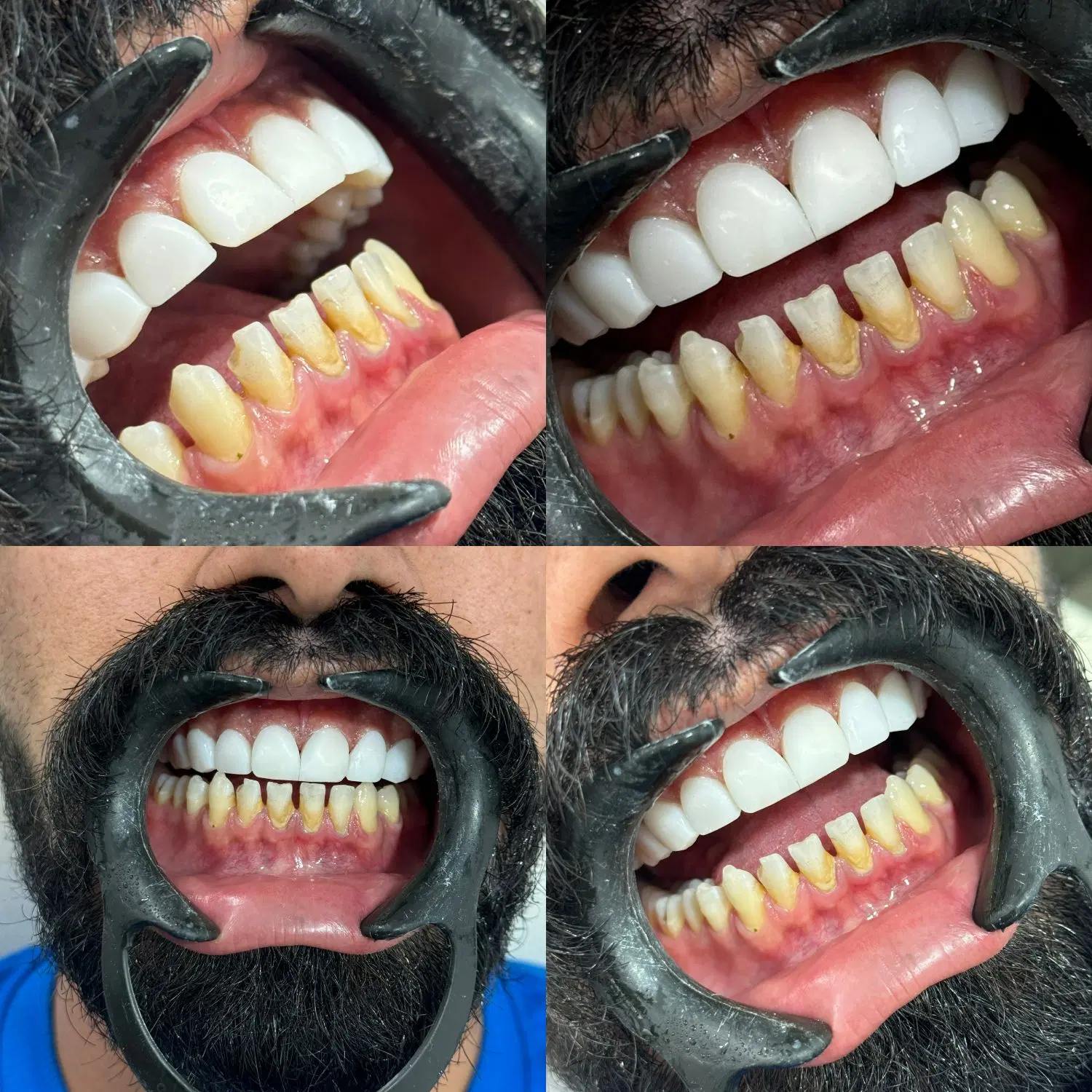 کامپوزیت دندان نانوسرامیک فکی ۸ میلیون تومان|خدمات زیبایی و سلامت|اهواز, نادری|دیوار
