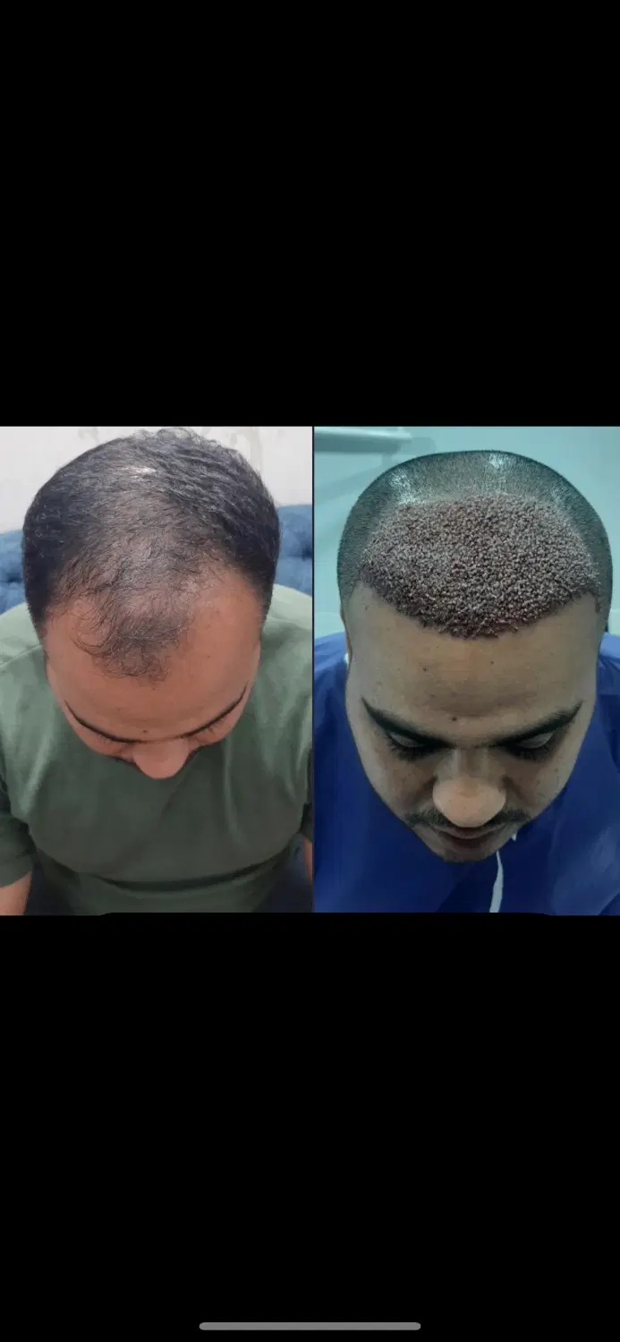 کاشت مو اقتصادی فقط ۲۰ تومن|خدمات زیبایی و سلامت|تهران, شهرک آزمایش|دیوار
