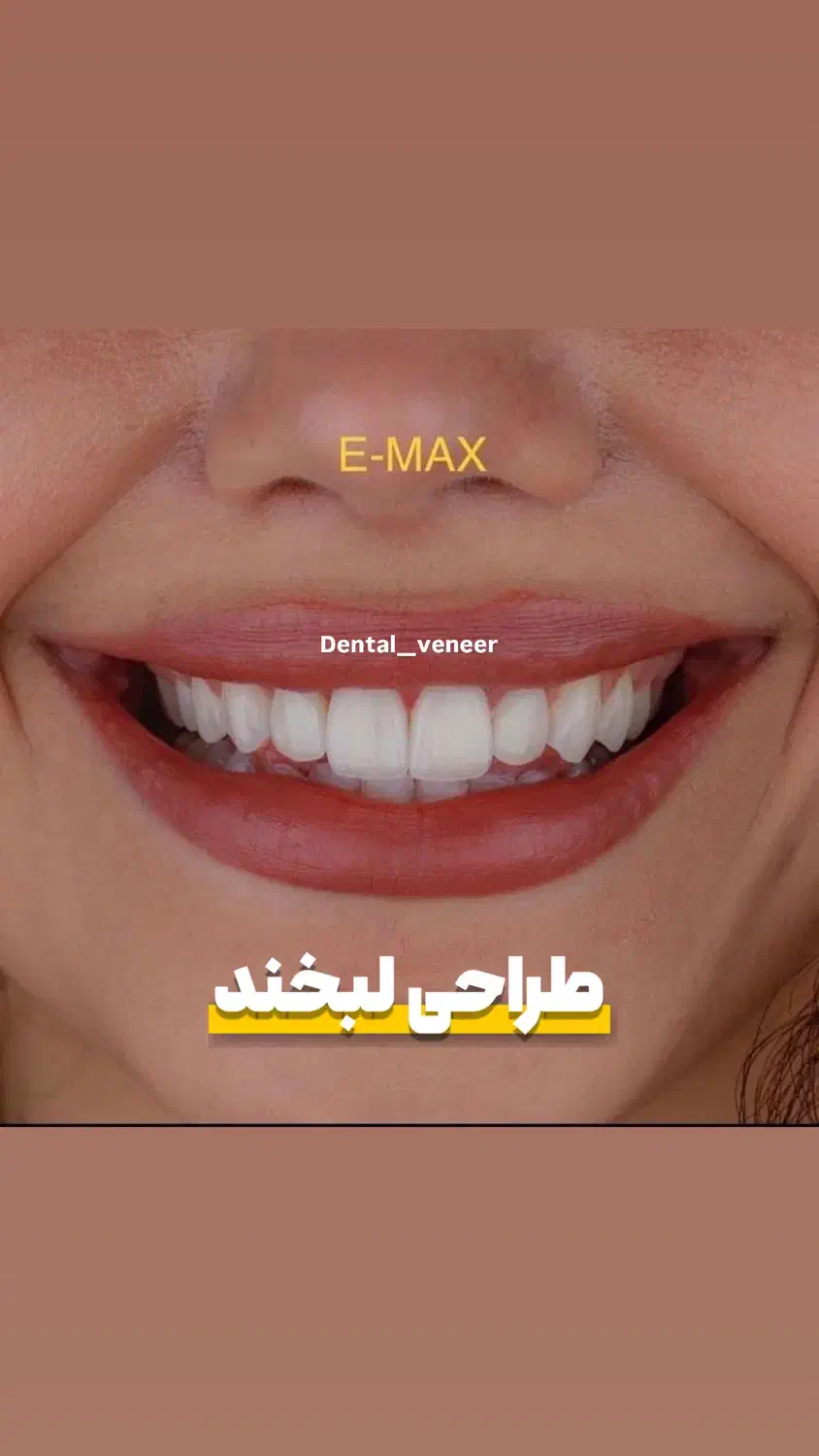دندانپزشکی دنتال ونیر کامپوزیت لمینت ایمپلنت|خدمات آرایشگری و زیبایی|تهران, تجریش|دیوار