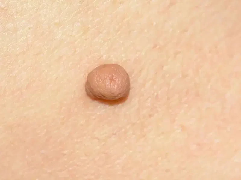 محلول برای رفع زائده پوستی|آرایشی، بهداشتی، درمانی|شیراز, شاهچراغ|دیوار
