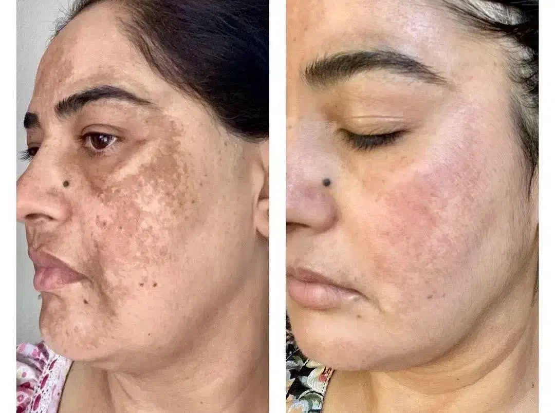 به مدل جهت انجام تکنیک آیینه سازی پوست|خدمات آرایشگری و زیبایی|ورامین, ورامین|دیوار