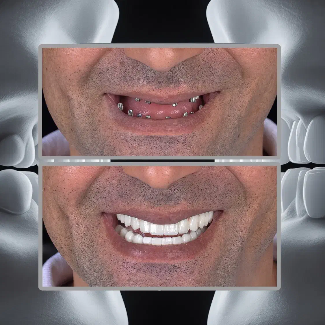 3 واحد ایمپلنت1واحد رایگان/جشنواره ایمپلنت دیجیتال|خدمات آرایشگری و زیبایی|تهران, هروی|دیوار