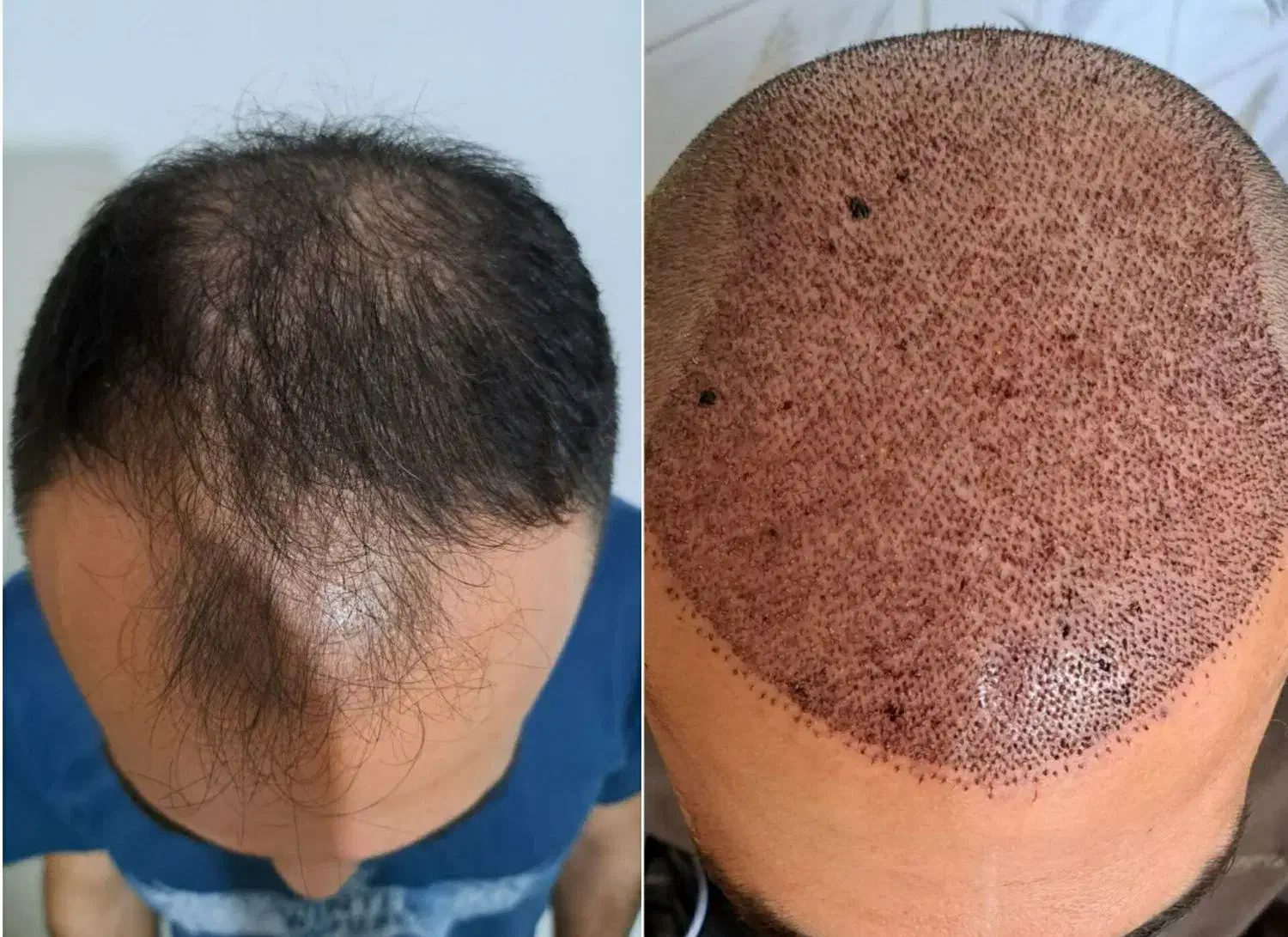 کاشت مو و ابرو|خدمات آرایشگری و زیبایی|تبریز, |دیوار