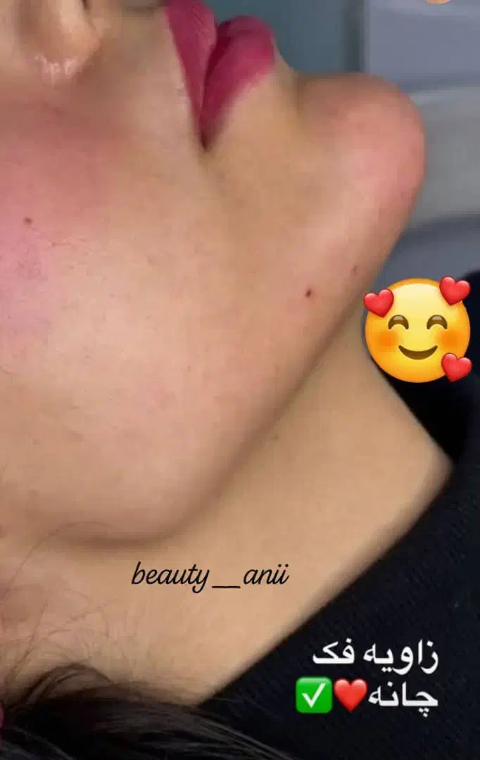 جشنواره ژل لب روسی و بوتاکس|خدمات آرایشگری و زیبایی|فردیس, شهرک ارم|دیوار
