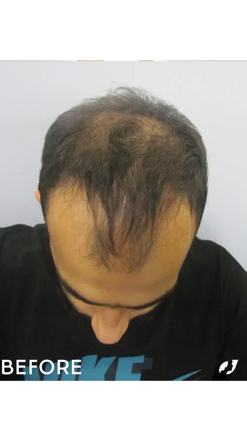 کاشت مو و ابرو|خدمات آرایشگری و زیبایی|تهران, جردن|دیوار