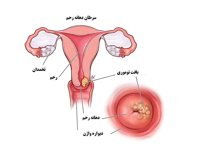 بهبودی کامل کیست فیبروم و میوم رحمی و نازایی|خدمات آرایشگری و زیبایی|کردکوی, |دیوار